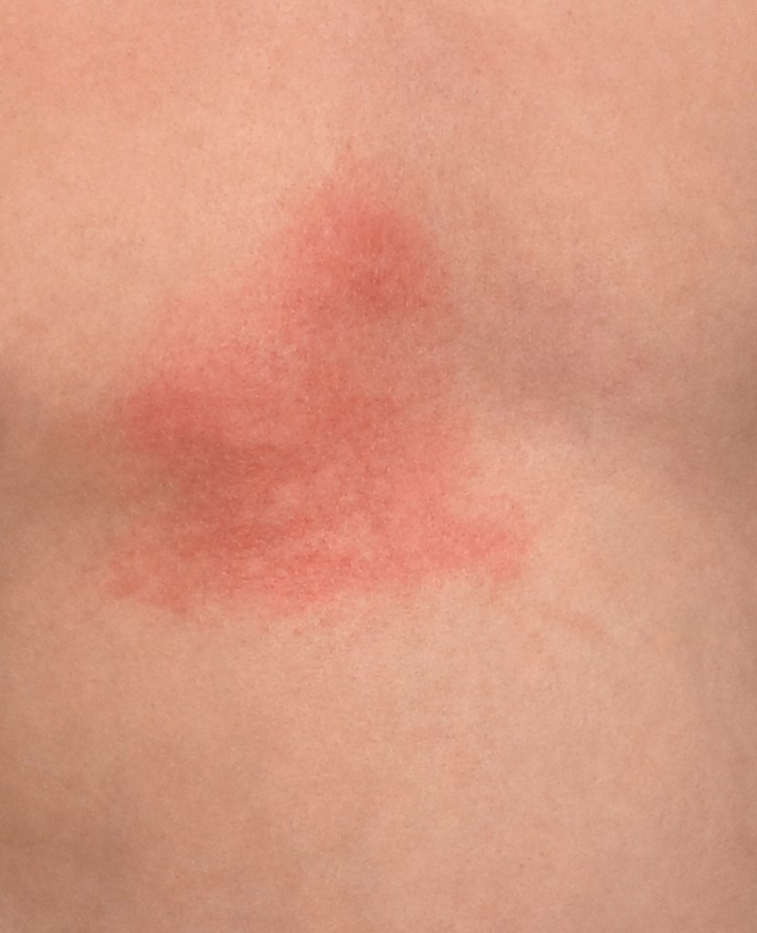 Hollis' First Rash_Our Experience with Incomplete Kawasaki Disease in a Toddler