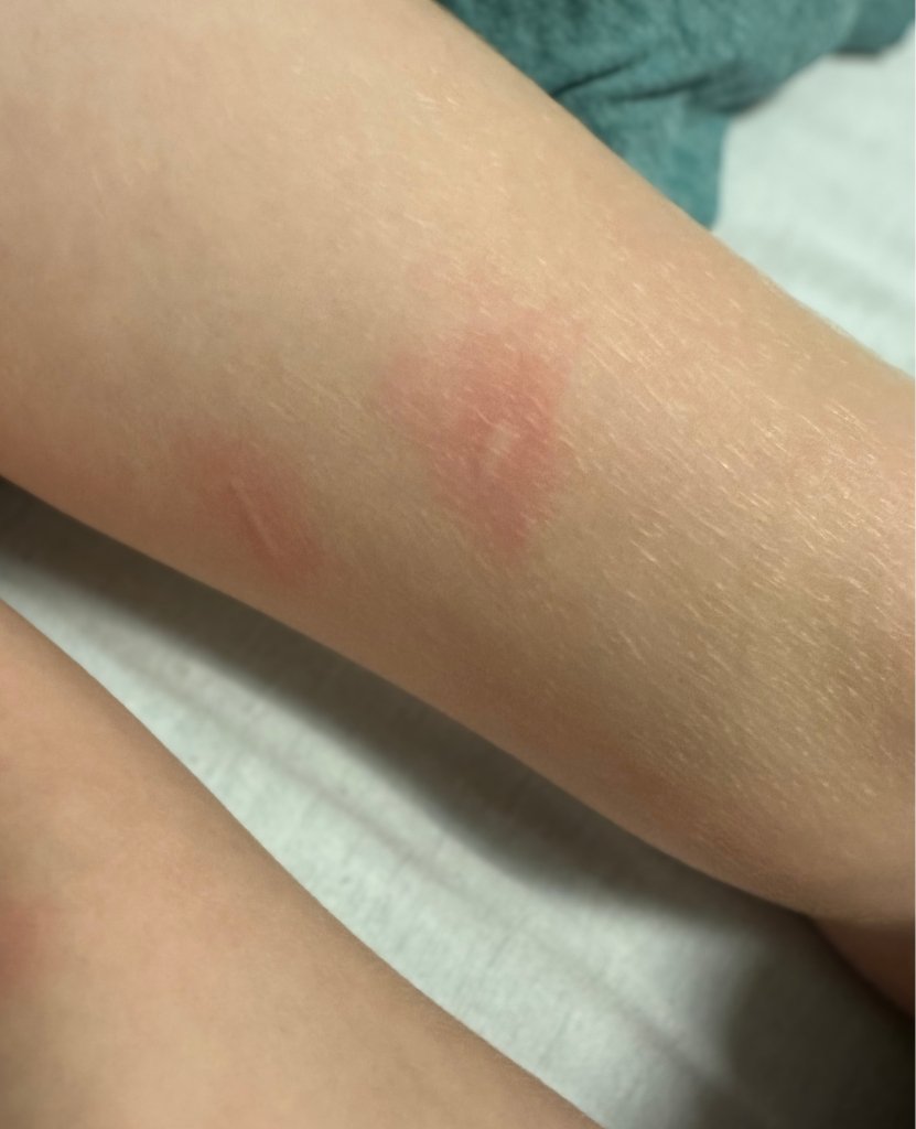 Hollis Leg Rash_Our Experience with Incomplete Kawasaki Disease in a Toddler