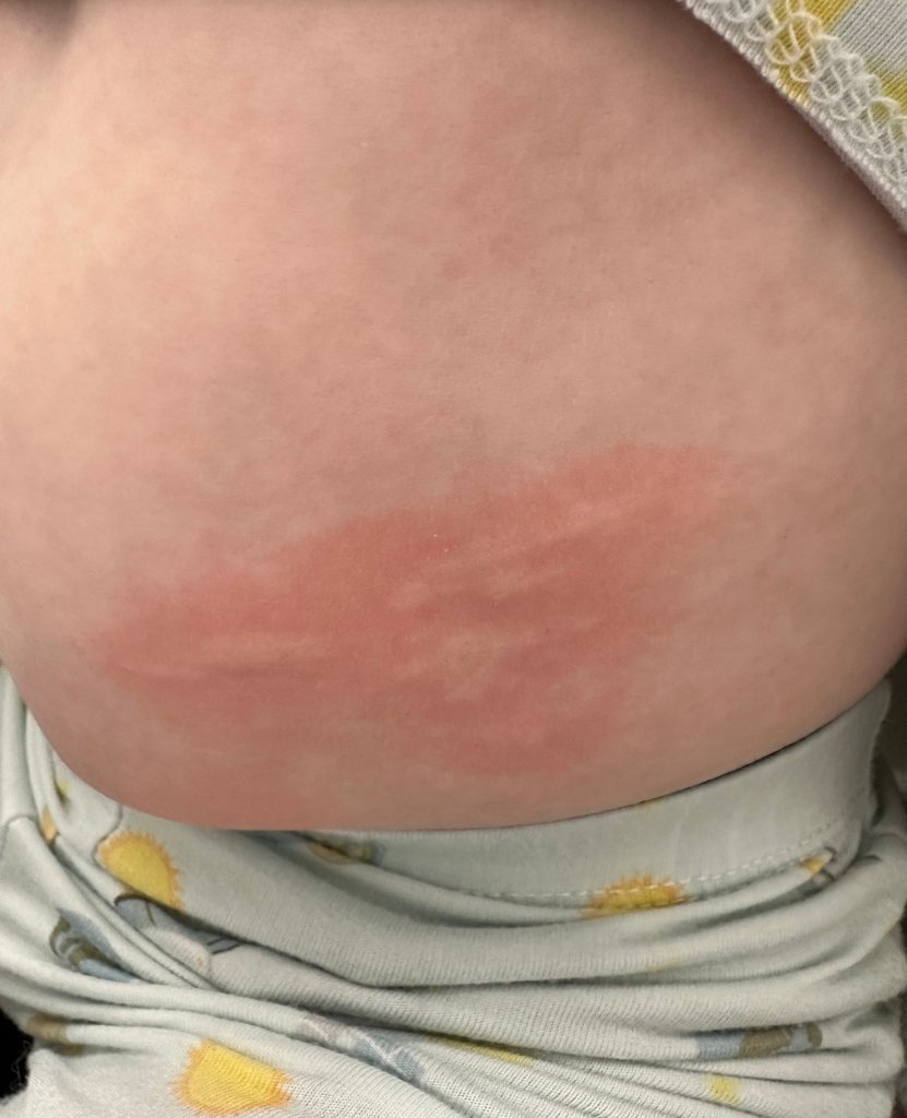 Hollis' Second Rash_Our Experience with Incomplete Kawasaki Disease in a Toddler