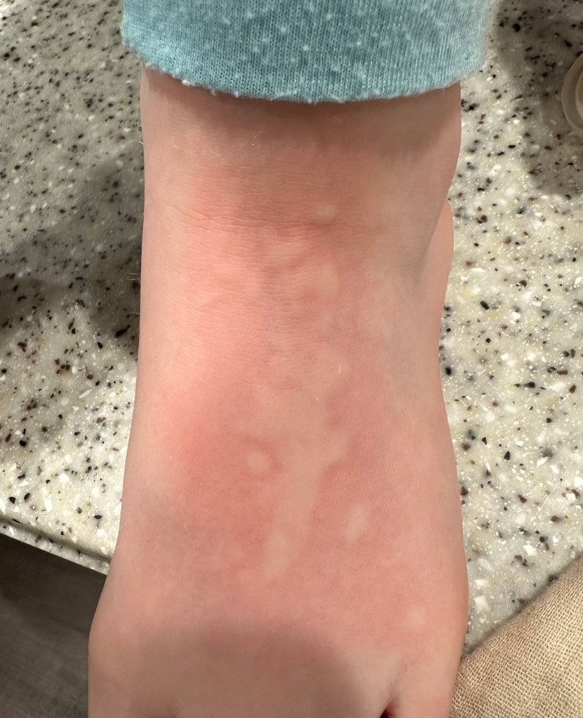 Hollis' Third Rash_Our Experience with Incomplete Kawasaki Disease in a Toddler